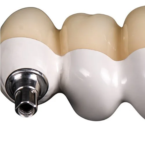 Implantat Zahnkrone Keramik Zahnersatz Fräszentrum digitale Fertigung Zahnarzt Labor präzise Dentaltechnik