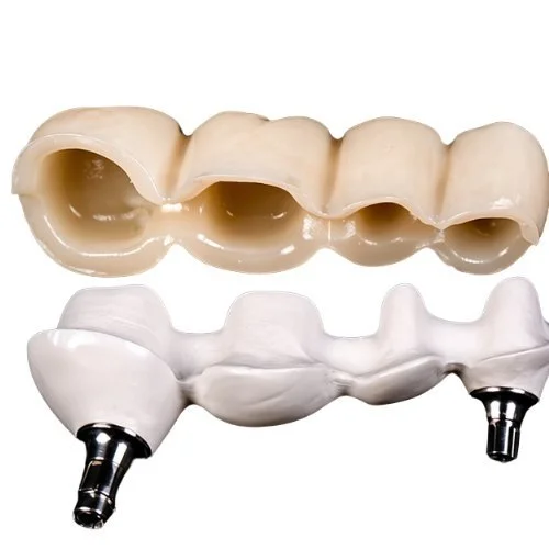 Zahnbrücke Implantat Zahnersatz Keramik Fräszentrum digitale Fertigung Zahnarzt Labor präzise Dentaltechnik