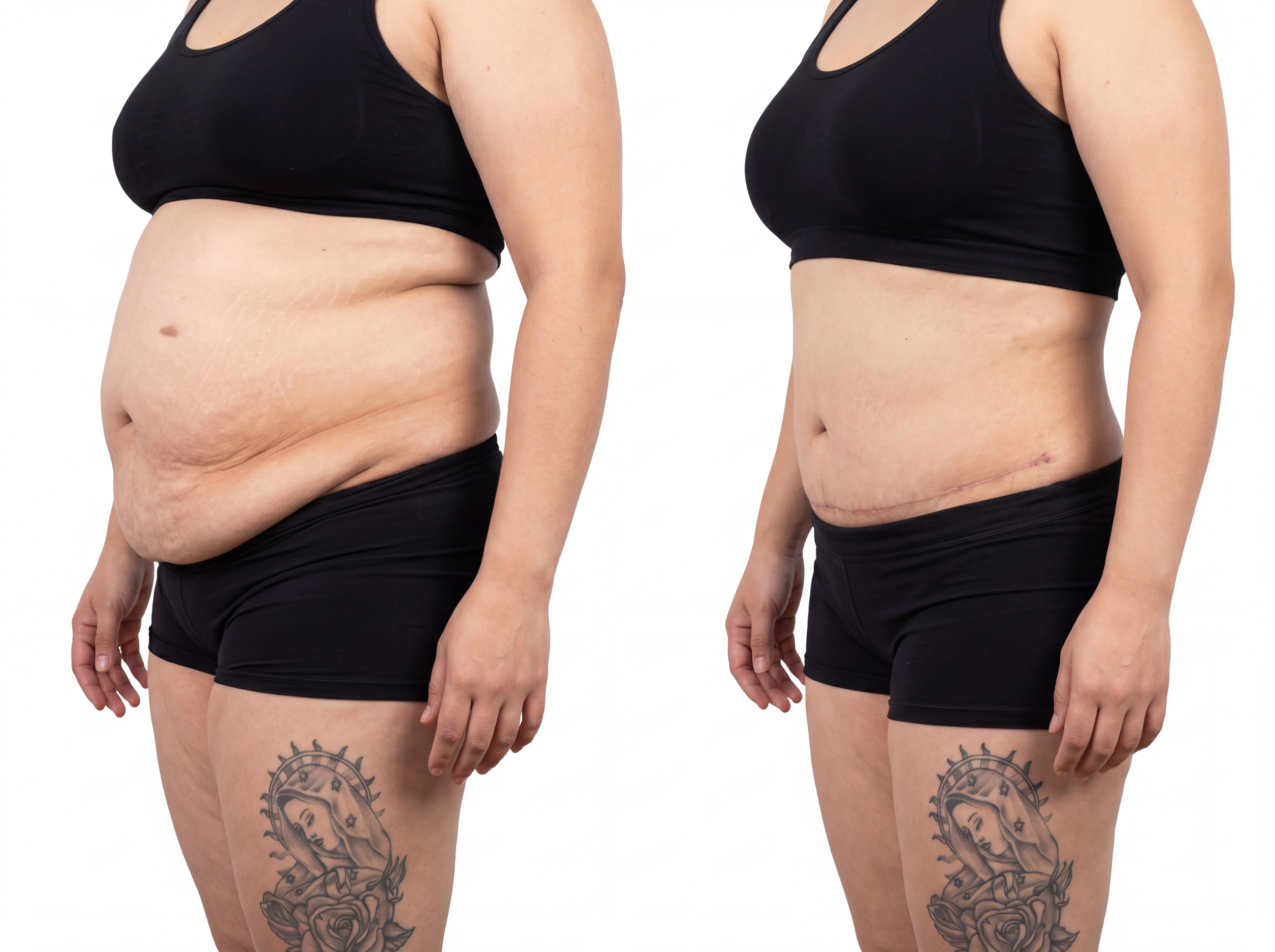 tummy tuck_V2.png