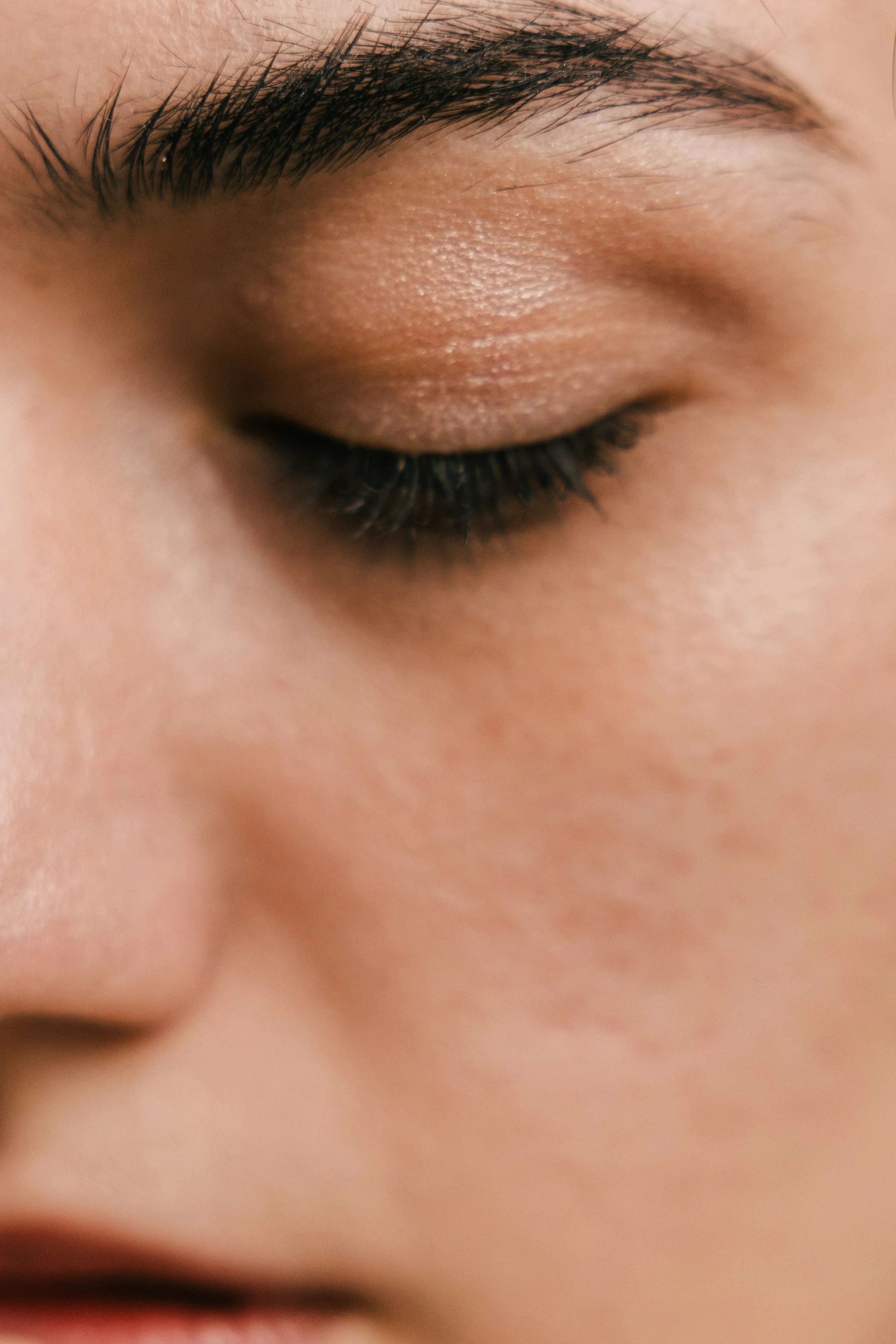 Blepharoplasty