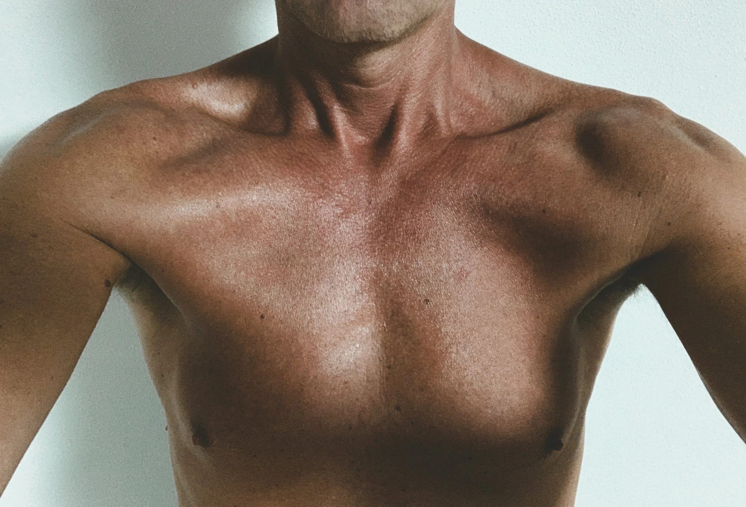 Gynecomastia