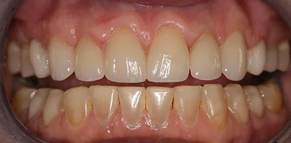 Close-up of a person's mouth showing upper and lower teeth with some yellowing and plaque buildup