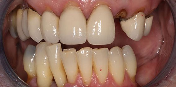 Close-up of upper and lower teeth with dental issues, including missing, decayed, and damaged teeth.