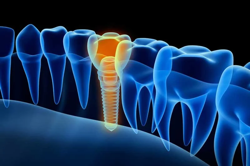 The Top 4 Benefits of Same-Day Dental Implants