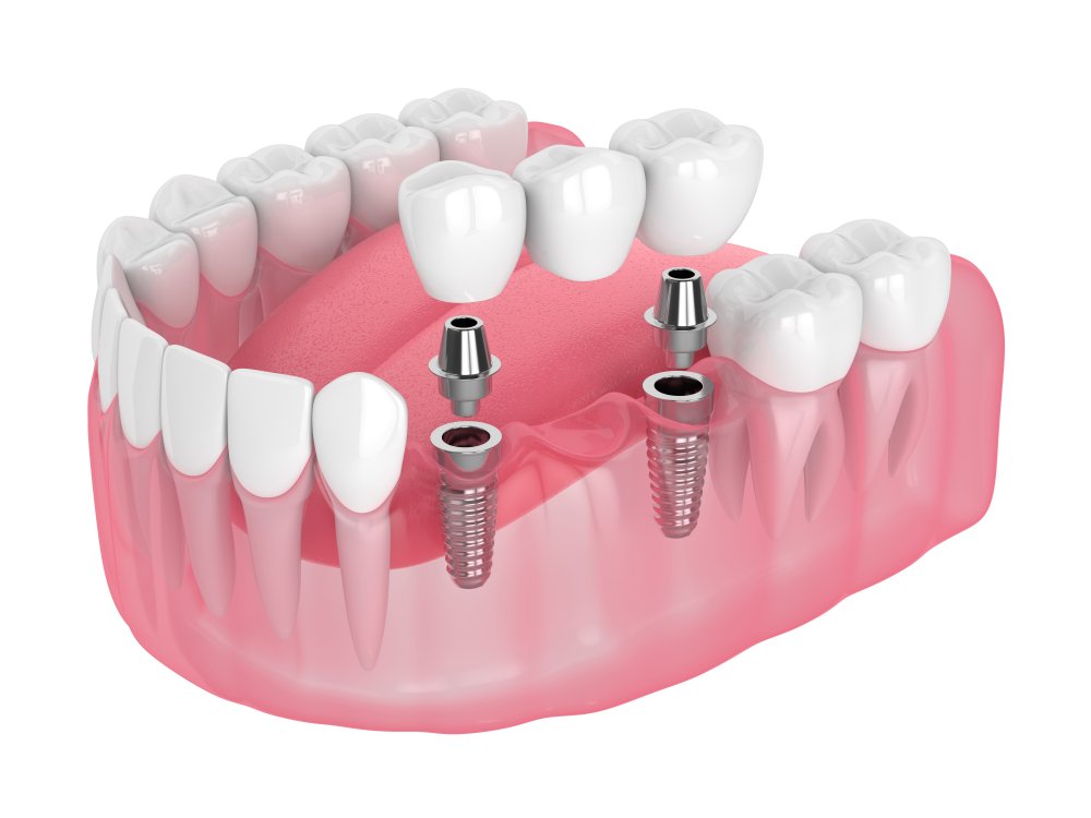 Comparing Implant Supported Bridges with Traditional Dental Bridges