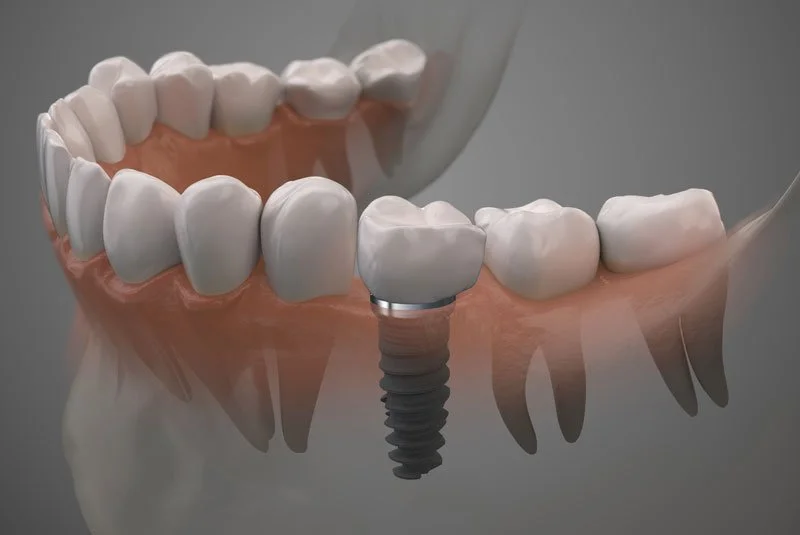 Top Questions Patients Ask About Dental Implants