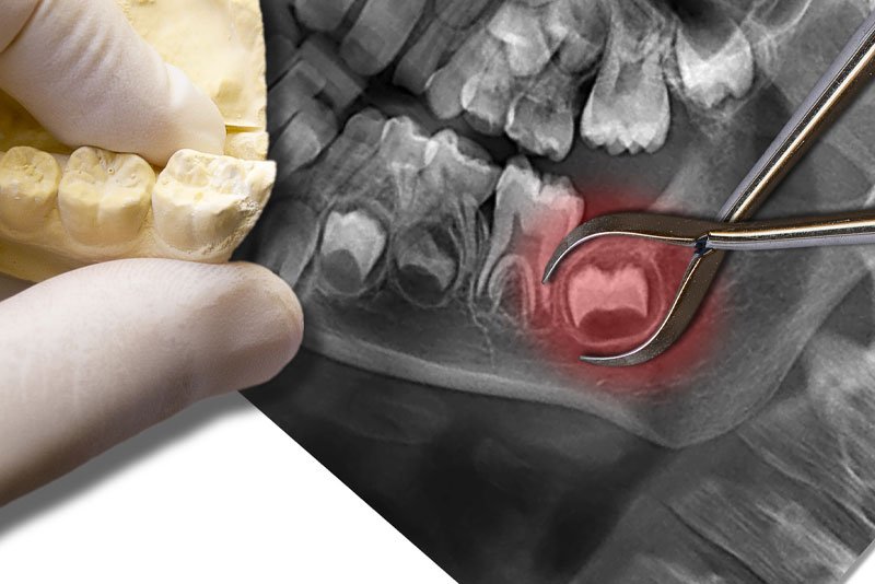 The Holidays:  A Great Time for Wisdom Teeth Removal