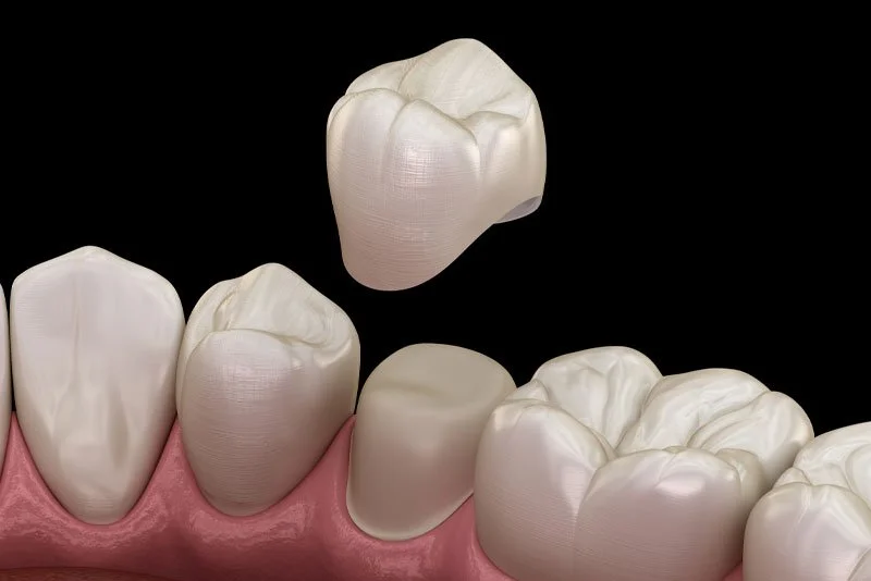 CEREC Crowns: A Quick Fix When You Need It Most