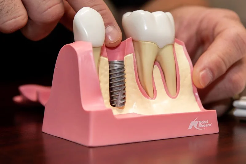 Replace Missing Teeth with Dental Implants by the Holidays