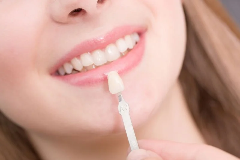 How Stain Resistant are Porcelain Veneers?