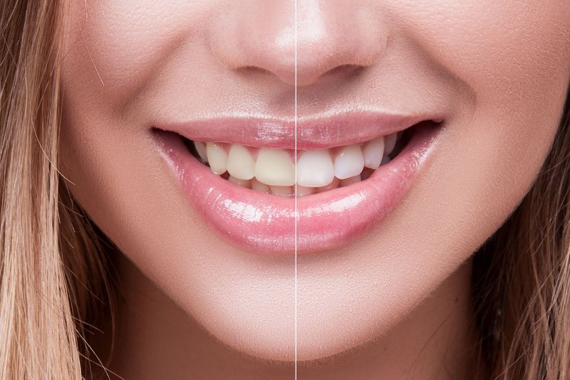 Fall in Love with Your Smile Again with Teeth Whitening!