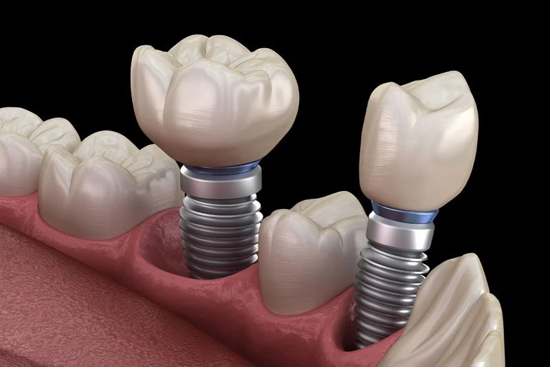 Are There Aesthetic And Functional Benefits To Getting Treated With Multiple Dental Implants?
