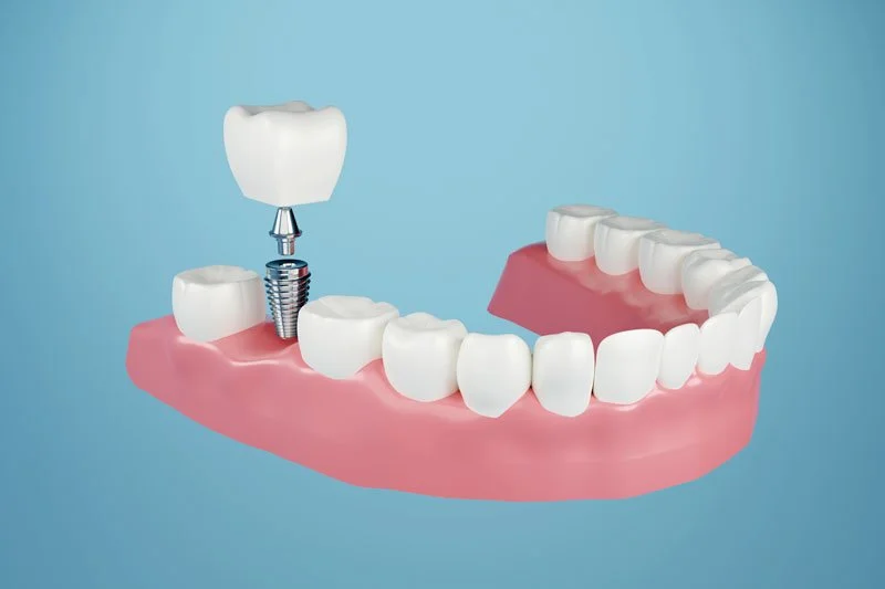 Are There Factors That Determine Which Type Of Dental Implant Procedure I Will Need To Restore My Smile?