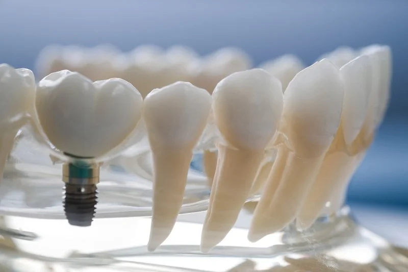 After My Dental Implants Are Placed, How Will I Know If I Have Peri-Implantitis?