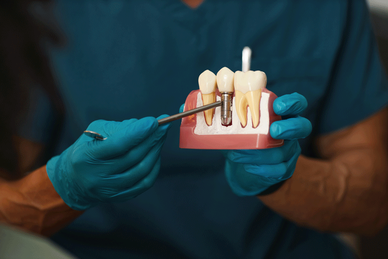 Understanding the Molar Implant Procedure: A Comprehensive Guide