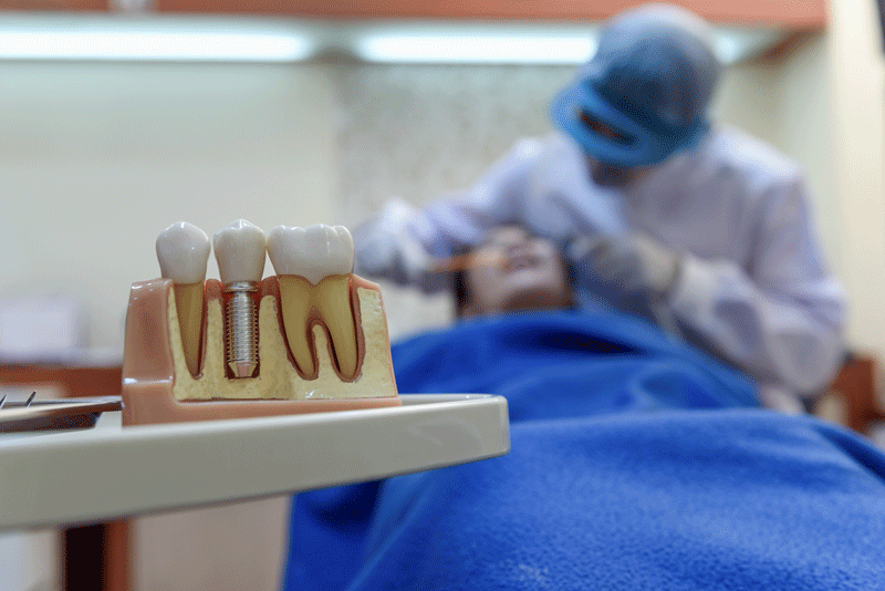 Demystifying Dental Implants: A Comprehensive Guide to This Dental Procedure
