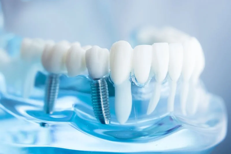Complete Tooth Implants: Your Essential Guide to a Lasting, Confident Smile