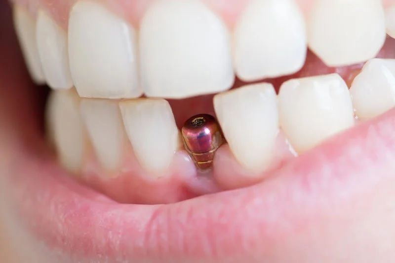 Understanding Dental Implants: How and When You Can Get All Your Teeth Replaced