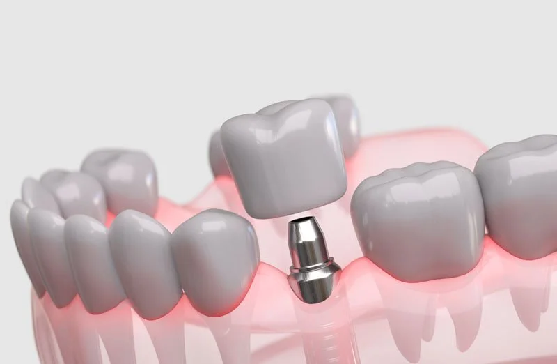 The Complete Dental Implant Process: Your Comprehensive Patient Guide