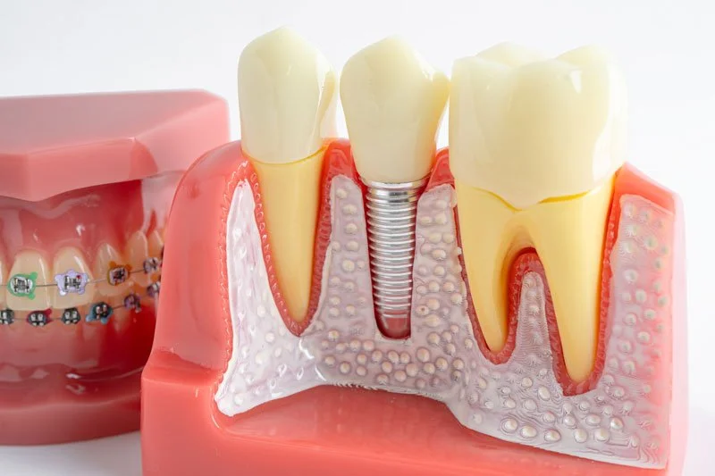 Transform Your Smile with a Front Tooth Implant: A Step-by-Step Dental Guide