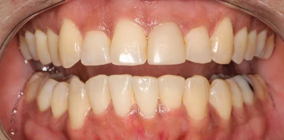 Close-up of a person's open mouth showing upper and lower teeth with some crowding and misalignment.