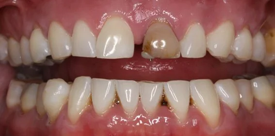 Close-up of teeth with severe decay, discoloration, and dental damage, including missing and broken teeth, and inflamed gums.