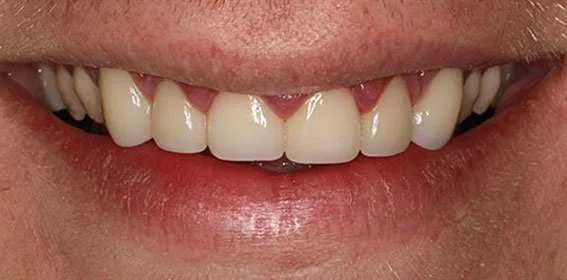 Close-up of a person's smile showing their upper front teeth and gums.