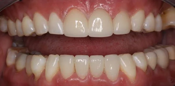 Close-up of a person's upper and lower teeth, showing dental alignment and health.