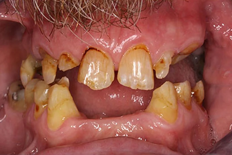 Close-up of severely decayed and stained teeth with significant plaque buildup and gum recession.