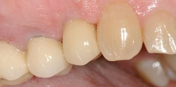 Close-up of human teeth and gums showing dental crowns or veneers.