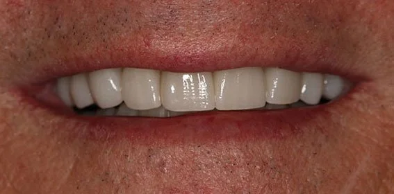 Close-up of a smiling person's mouth showing white teeth.
