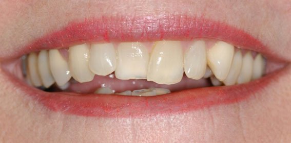 Close-up of a person's mouth showing misaligned, stained teeth.