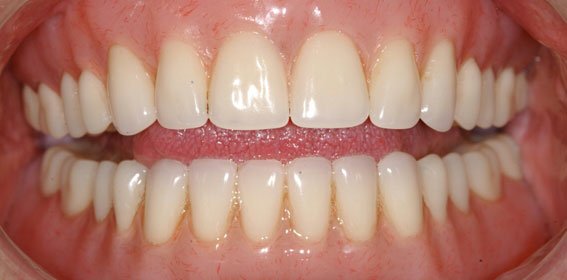 Close-up of a person's open mouth showing clean, healthy teeth and gums.