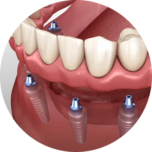 A dental model showing a lower jaw with dental implants and a set of artificial teeth.