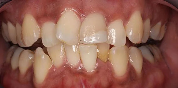 Close-up of crowded and crooked teeth with gaps and discoloration.
