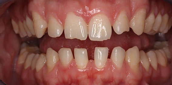 Close-up of a person's mouth showing misaligned and crooked teeth with gaps.