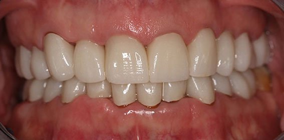 Close-up of a person's teeth showing dental restoration and some misalignment.