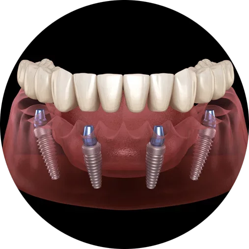 A dental model displaying dental implants with a set of artificial teeth attached.