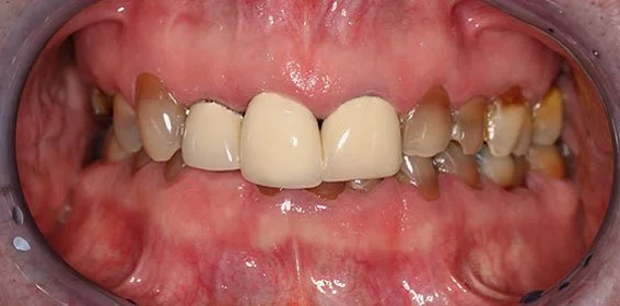 Close-up of a mouth with severe dental decay and missing teeth.