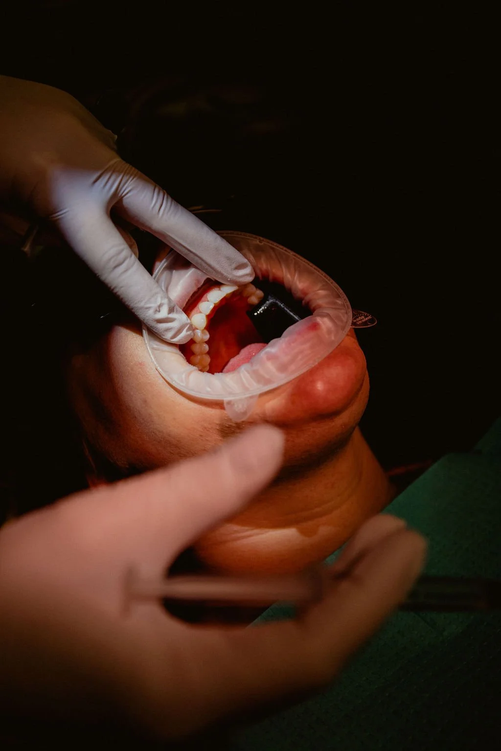 A person wearing gloves performing a dental procedure inside a mouth with a dental dam.