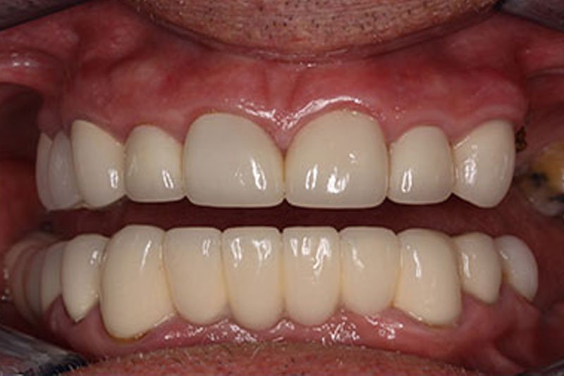 Close-up of a person's mouth showing upper and lower teeth with dental prosthetics or crowns.