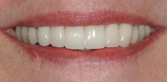 Close-up of a person's smiling mouth showing white teeth.