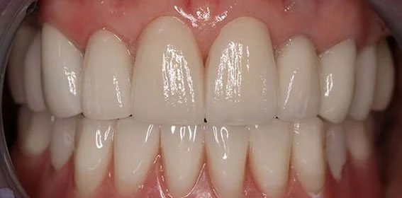 Close-up of a person's teeth showing a full set of upper and lower teeth.