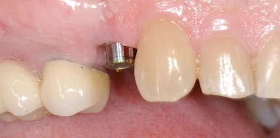 Close-up of a person's upper front teeth, showing a dental implant abutment without a crown.