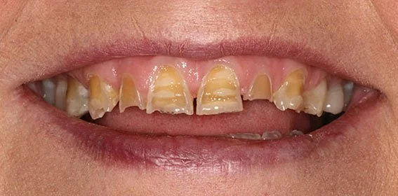 Close-up of a person's mouth showing severely decayed and damaged teeth.