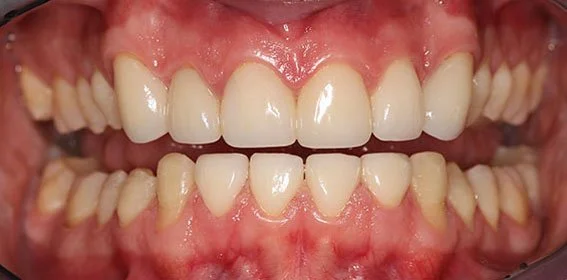 Close-up of crowded lower and upper teeth with some signs of dental crowding and misalignment.