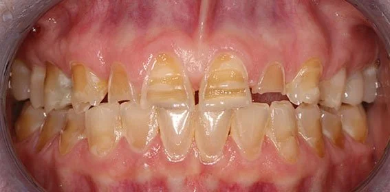 Close-up of a person's teeth showing significant dental misalignment and plaque buildup.