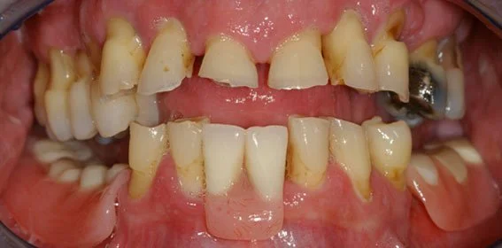 Close-up of severely decayed and missing upper and lower teeth with gum inflammation.