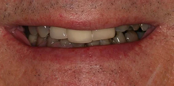 Close-up of a person's smile showing uneven and missing teeth.