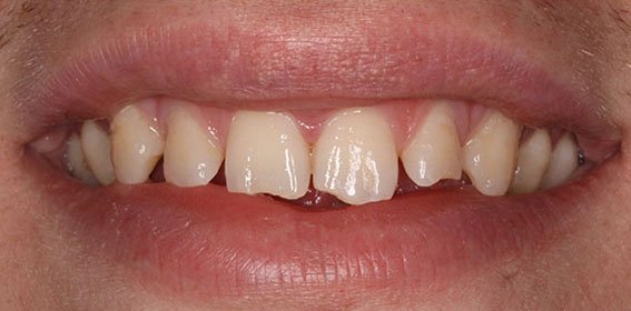 Close-up of a person's smile showing crooked, misaligned teeth.